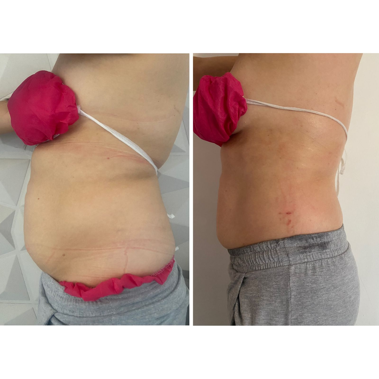 Resultado de Tratamiento Facial