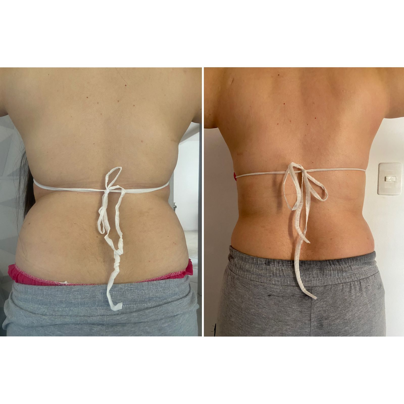 Resultado de Tratamiento Corporal