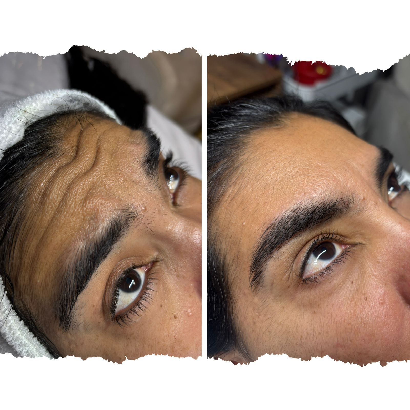 Resultado de Procedimiento Estético